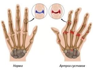 лечение на артроза на пръстите в Москва